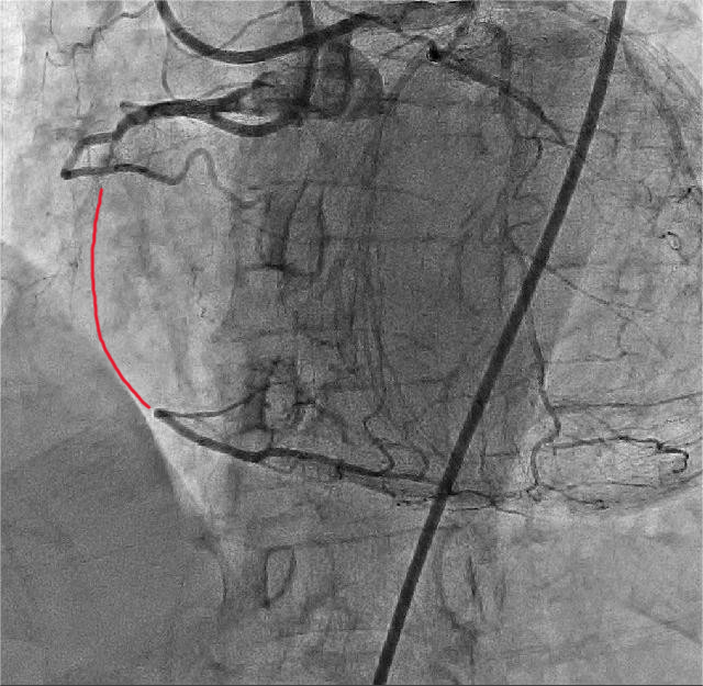 闭塞血管 闭塞血管